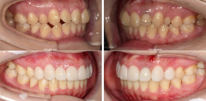 잇몸미소 인비절라인 거미스마일 토끼이빨 교정 무삭제 라미네이트 반대교합 치료 후기 관련 이미지 19
