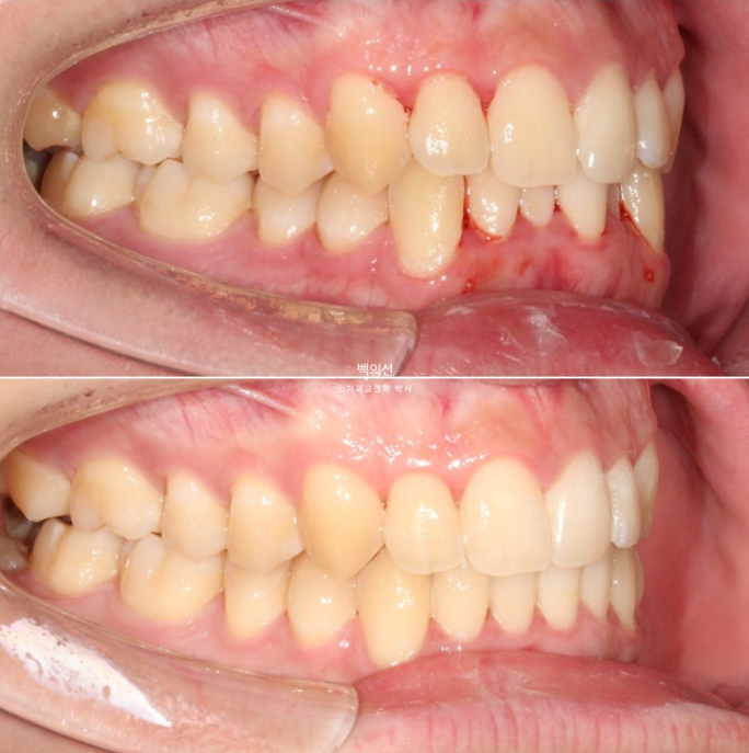 유학생 교정 인비절라인 라이트 치료기간 5개월 관련 이미지 14