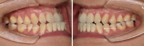 Is Invisalign Treatment Possible After Double-Jaw Surgery? A Real One-Year Case of Surgery-First Orthodontic Treatment image 2