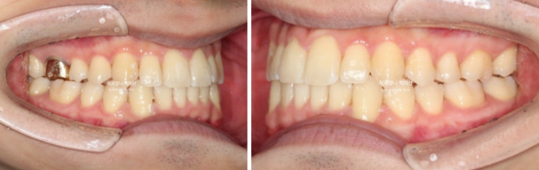 인비절라인 비발치 앞니 돌출 교정 치료기간 2년 5개월 관련 이미지 10