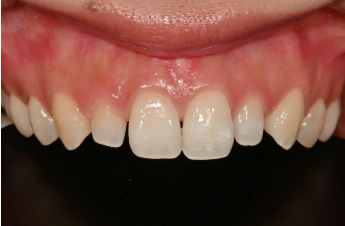 왜소치 반점치 (반상치)가 있는 경우 무삭제 라미네이트 치료 관련 이미지 4