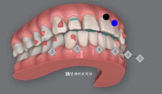 50대 60대 중년 치아 벌어짐 단기 교정 해결하기 관련 이미지 7