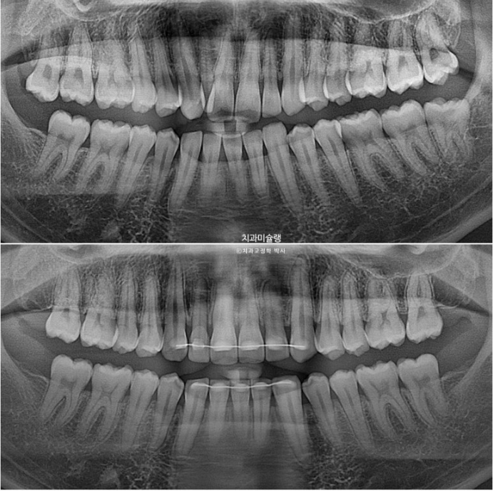 옥니 덧니 교정 왜소치 선천적 결손 3전치 무삭제 라미네이트 인비절라인 교정 관련 이미지 25