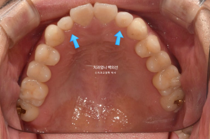 주걱턱 교정 반대교합 소구치 선천적 결손 부정교합 비발치 교정 후기 관련 이미지 5