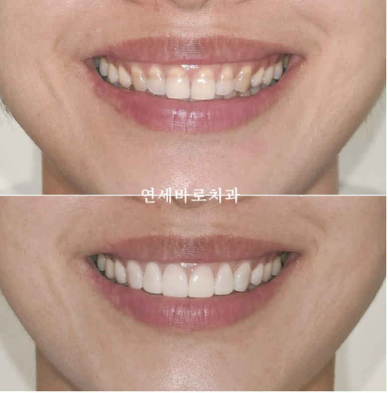 라미네이트 하고 후회하는 경우와 만족하는 경우의 차이 관련 이미지 9