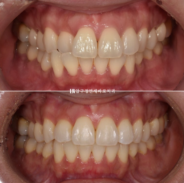 Short-Term Orthodontic Treatment Period for an Overseas Korean in Their 40s with Anterior Crossbite and Buck Teeth image 1