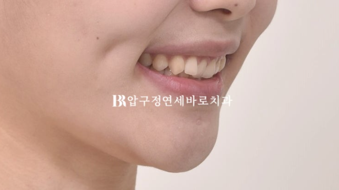 압구정 교정치과 / 옥니교정 인비절라인 라이트 덧니교정 관련 이미지 5