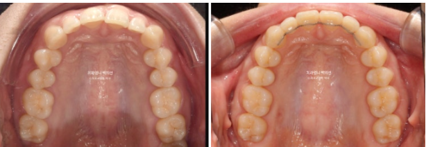 Inward-Tilted Teeth Orthodontic Treatment Review | Actual Case Improved with Non-Extraction Orthodontic Treatment for Gummy Smile, Deep Overbite & Gum Asymmetry — Gangnam Orthodontic Clinic image 12