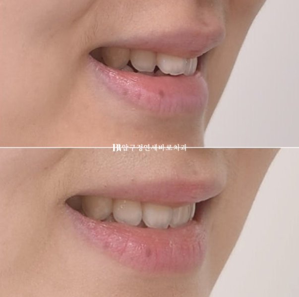 토끼이 교정, 인비절라인 익스프레스로 가능할까?앞니 부분교정 4개월 치료 증례 소개 관련 이미지 15