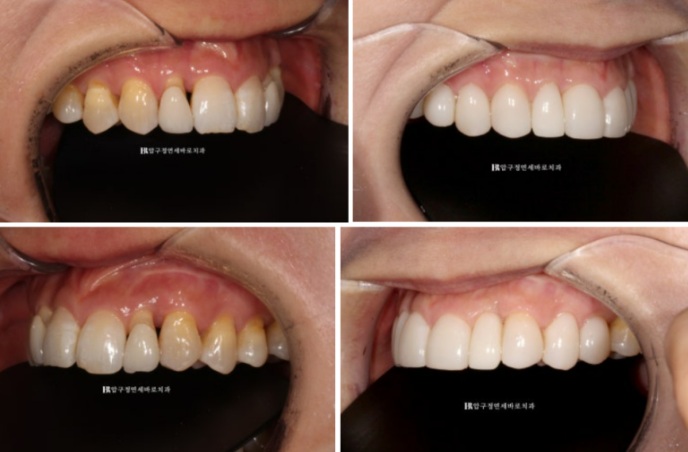 40대 오래된 크라운 교체 / 블랙트라이앵글 젤라미 치료 결과 관련 이미지 5