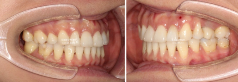 옥니 교정 역교정 재교정 무턱교정 치료기간 1년 10개월 관련 이미지 15