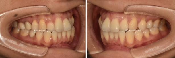 Gangnam Orthodontic Clinic: A Woman in Her 30s’ Rabbit Teeth Correction Review|Six-Month Front Teeth Partial Orthodontic Treatment That Also Improved a Crossbite image 3