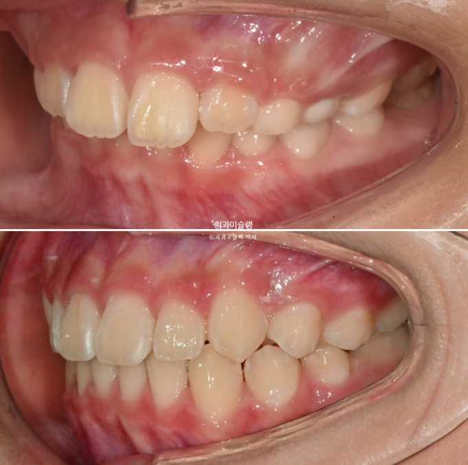 어린이 돌출입 교정 무턱 투명교정 인비절라인 퍼스트 관련 이미지 21
