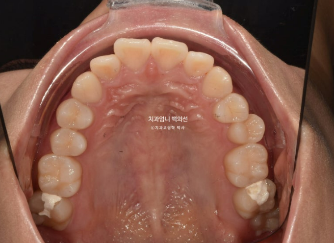 앞니 부분 교정 토끼이빨 덧니교정 ? 관련 이미지 5