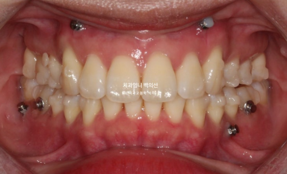 돌출입 교정 인비절라인 발치 교정 후기 관련 이미지 9