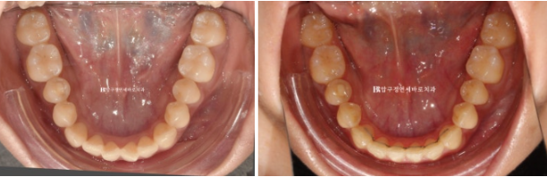 인비절라인 익스프레스 토끼이빨 교정 기간? 인비절라인 종류는? 관련 이미지 14