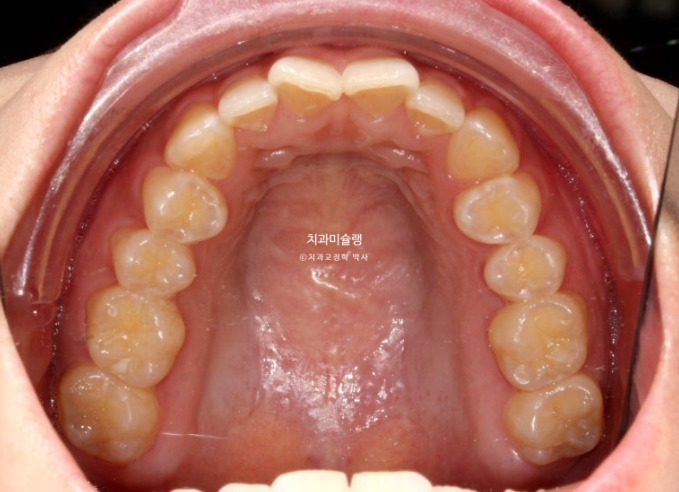 선수술 양악수술 비대칭 주걱턱 잇몸미소 치료 인비절라인 라이트 관련 이미지 5