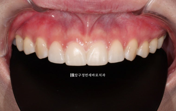 If Your Front Teeth Look Spaced Due to Peg-Shaped Teeth or Microdontia: A Case Choosing No-Prep Veneers Instead of Orthodontic Treatment image 6