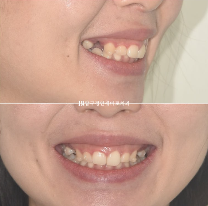 인비절라인 돌출입 발치교정 거미스마일 잇몸미소 교정 관련 이미지 3