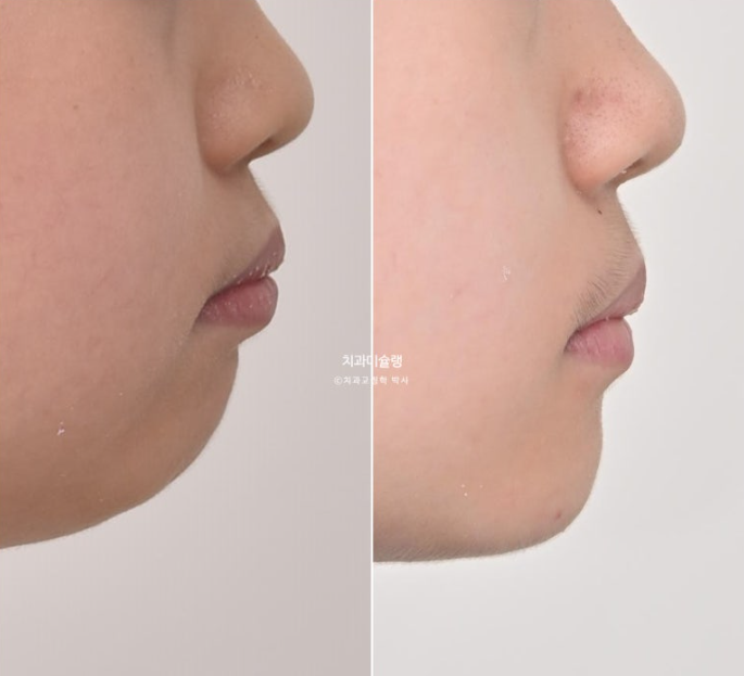 선천적 결손 잔존유치 과개교합 돌출입 인비절라인 퍼스트 어린이 투명교정 치료기간 관련 이미지 25