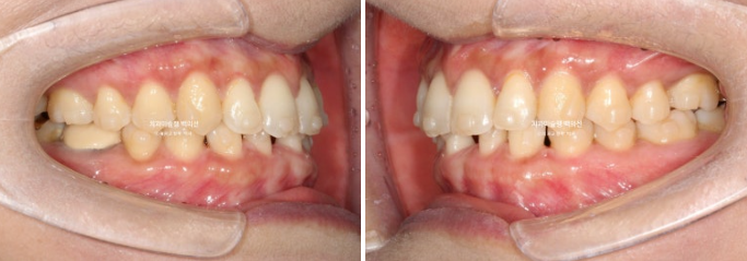 해외거주 앞니 선천적 결손 과개교합 인비절라인 라이트 브릿지 치료 관련 이미지 8