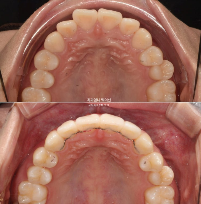 앞니 부분 교정 급속 교정 토끼이빨 MTA 미니튜브 치간삭제 치료기간 9개월 관련 이미지 15