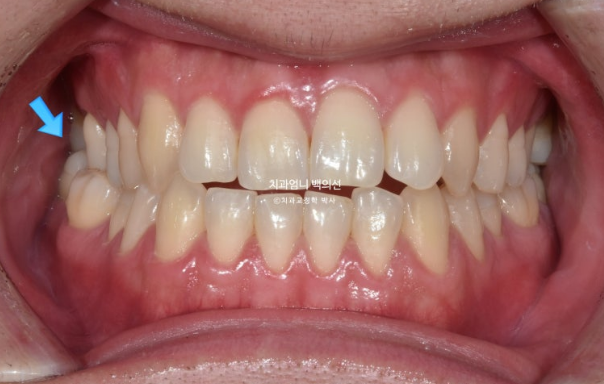 MSE Palatal Expansion Invisalign Underbite Correction, Non-Surgical image 2