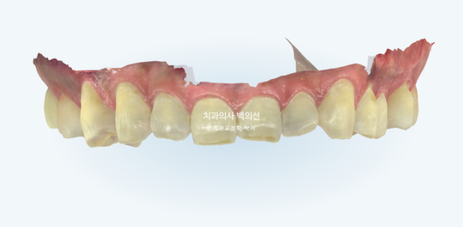 30대 주걱턱 비수술 비발치 교정 후기 관련 이미지 2