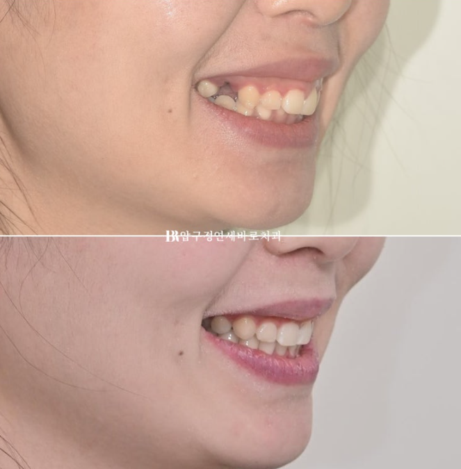 Does Invisalign Prevent Root Movement? Before-and-After Comparison of Extraction Treatment for Protruding Lips image 14
