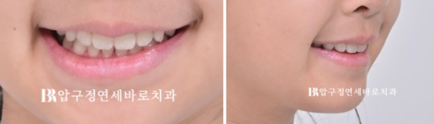 압구정 어린이교정 인비절라인 퍼스트 악궁확장 덧니 교정 관련 이미지 15