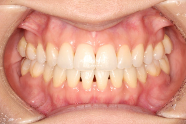 인비절라인 익스프레스 재교정 블랙트라이앵글 치간 삭제 치료기간 6개월 재제작 1회 관련 이미지 11