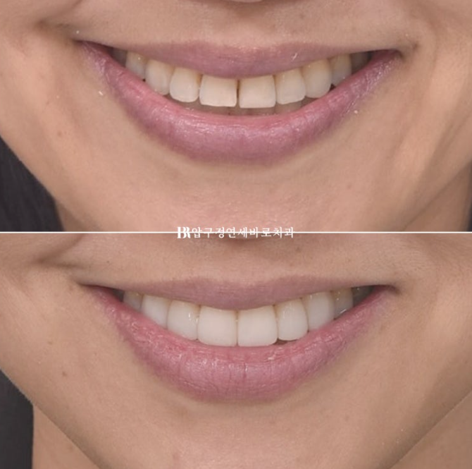 How to Avoid Regretting No-Prep Laminate Veneers: The Fitting Process Revealed image 5