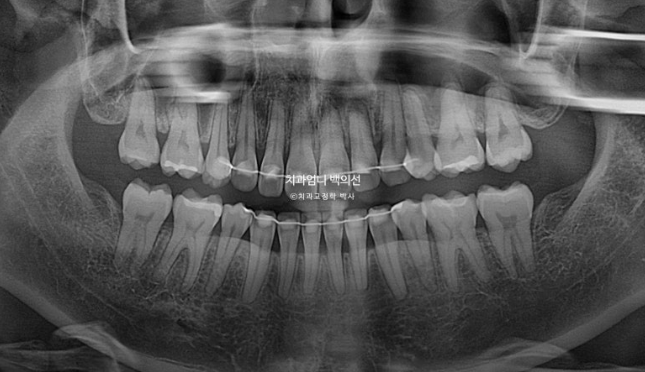 30대 돌출입 발치교정 입술부전증 치료 관련 이미지 18