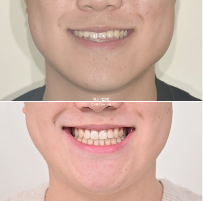 비수술 비발치 주걱턱 절충치료 클리피씨 개방교합 반대교합 치료 관련 이미지 16