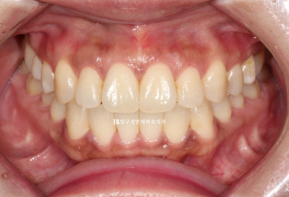 Is compliance important for Invisalign? | A real case that improved reverse bite and scissors bite in 8 months image 10