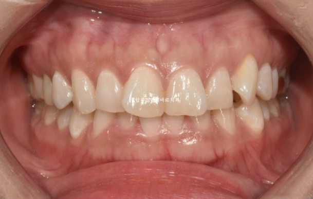 웃을 때 잇몸이 보여요. 잇몸미소 거미스마일 교정하기 관련 이미지 2