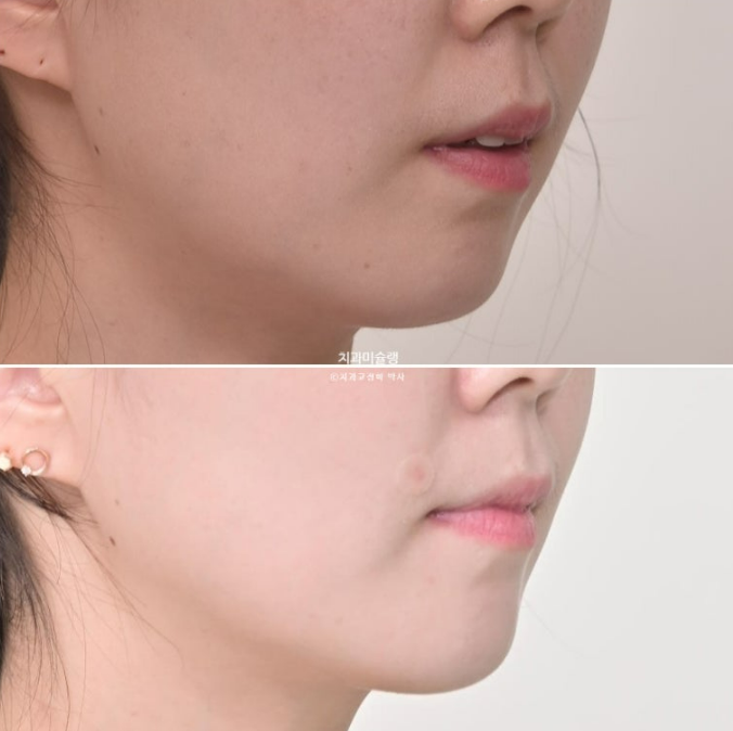 비발치 인비절라인 교정 편측 개방교합 가위교합 돌출 재교정 관련 이미지 22