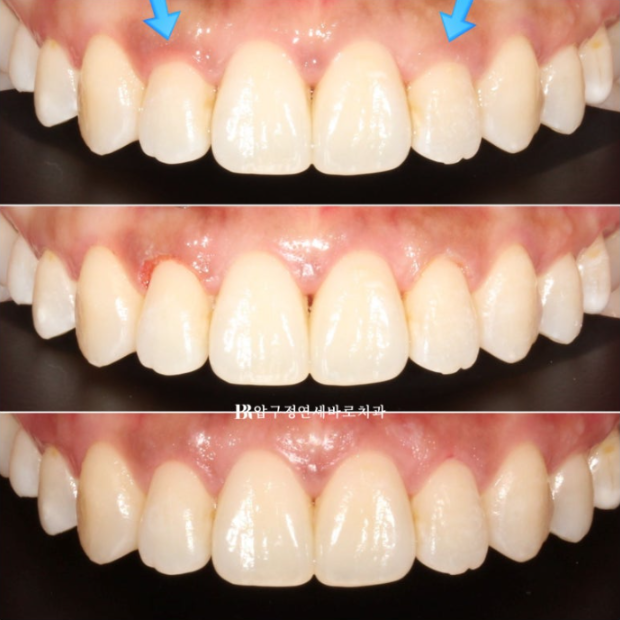 Invisalign Success Depends on Wearing Them Consistently|9-Month Real Treatment Case of Crowding & Underbite image 9