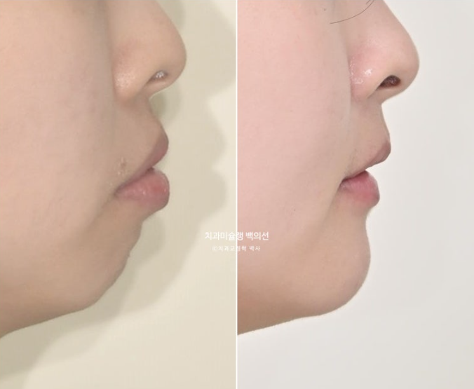 돌출입 인비절라인 발치교정 거미스마일 잇몸미소 잇몸돌출 입술부전증 무턱 재교정 관련 이미지 1