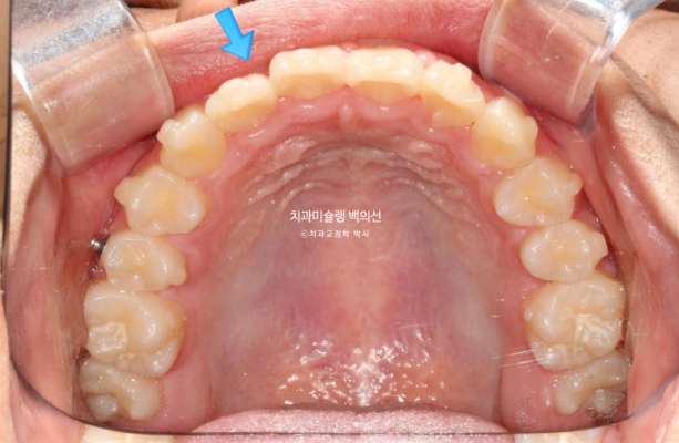 덧니 반대교합 과개교합 인비절라인 퍼스트 악궁확장 어린이 교정 관련 이미지 13