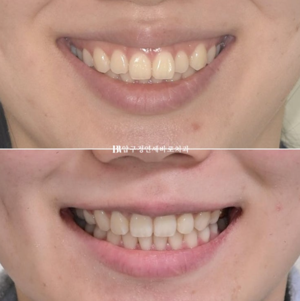 Gummy Smile Correction Review | Natural Improvement of Gummy Smile and Buccal Corridors Through Extraction Treatment for Protruding Teeth image 18