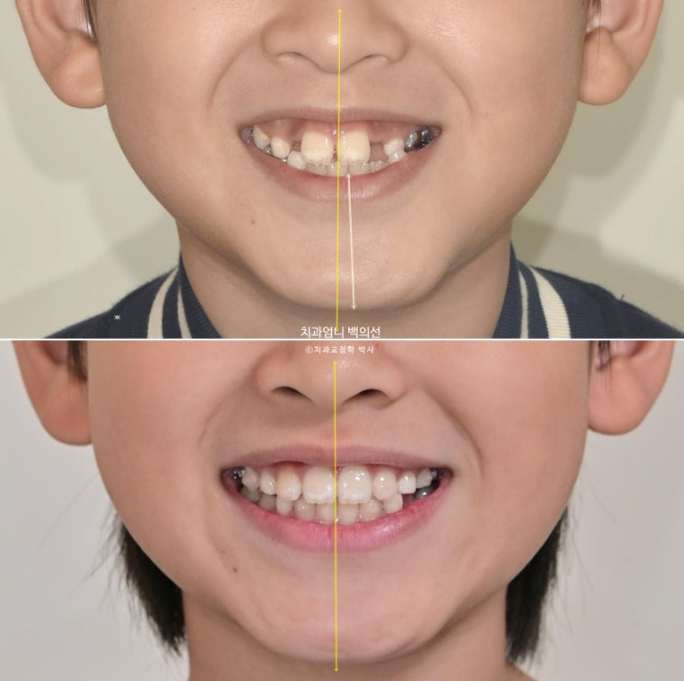 어린이 교정 인비절라인 퍼스트 비대칭 반대교합 어린이 성장 교정 관련 이미지 1