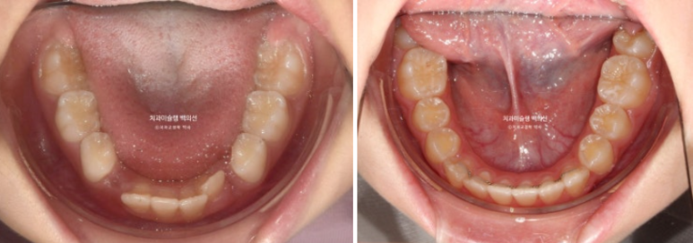 어린이 무턱 성장교정 덧니 인비절라인 퍼스트 악궁확장 치료기간 2년 관련 이미지 25