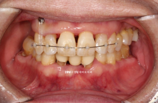 A 60s Patient’s Orthodontic Treatment Review | A Case Combining Partial Orthodontics for the Front Teeth After Periodontitis Treatment with No-Prep Veneers image 4