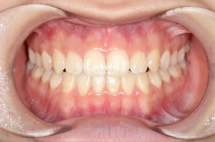 중학생 주걱턱 반대교합 개방교합 덧니 교정 인비절라인 후기 관련 이미지 7