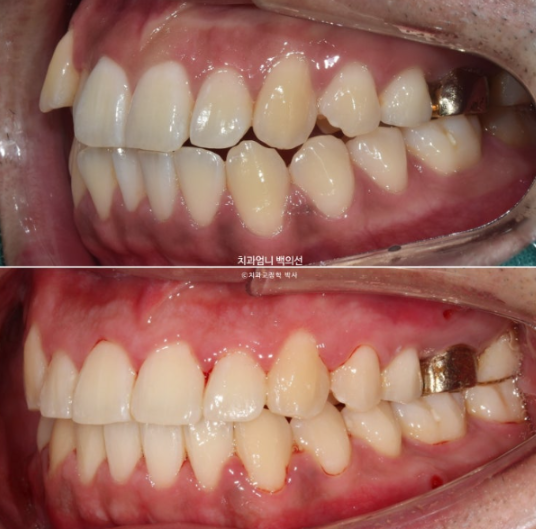 반대교합 비발치 교정 클리피씨 후기 관련 이미지 11