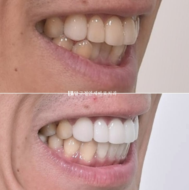 40대 치아교정 인비절라인 라이트 덧니 교정 어금니 교합 부작용 관련 이미지 17