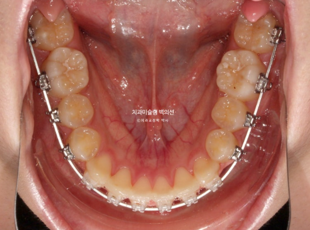 덧니 돌출입 발치교정 상악만 2개 편악 발치 클리피씨 입술부전증 치료 관련 이미지 9