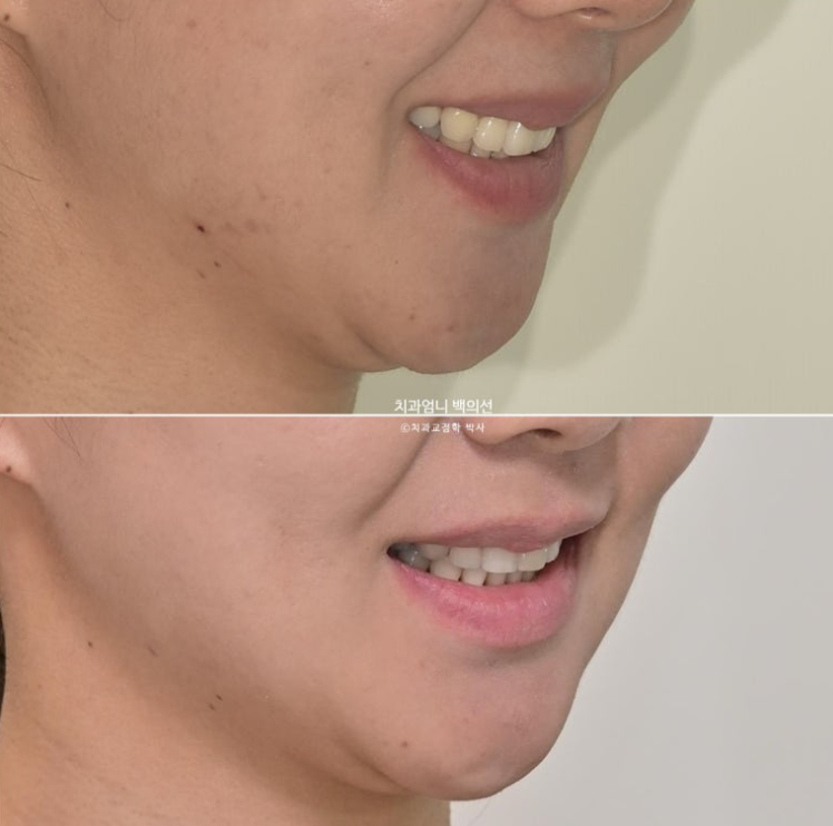 옥니 교정 역교정 재교정 무턱교정 치료기간 1년 10개월 관련 이미지 1