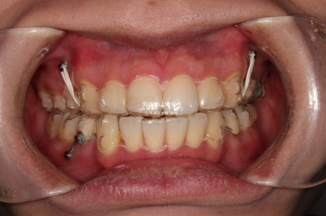 돌출입 발치 교정 인비절라인 후기 미니스크류 관련 이미지 7